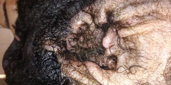 fulgyulladas2 Krónikus fülgyulladás