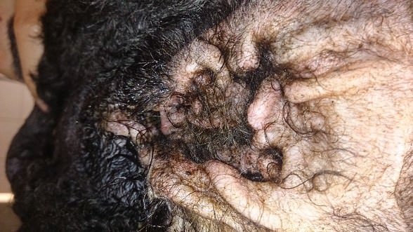 fulgyulladas2 Krónikus fülgyulladás